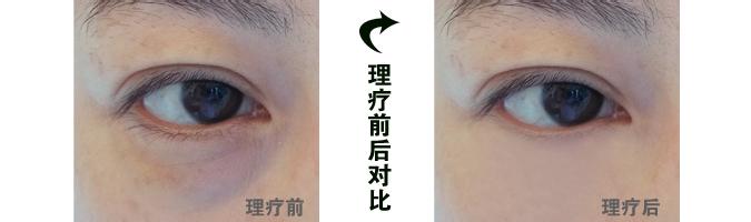 去黑眼圈眼袋小妙招 黑眼圈怎么治疗 黑眼圈的治疗小妙招