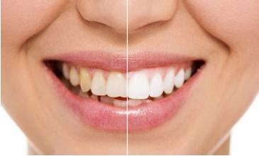 怎么美白牙齿最有效 怎么样可以美白牙齿