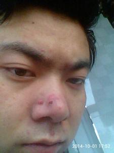 鼻子里面长痘痘的原因 鼻子里面长痘痘有什么原因