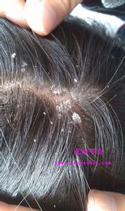 头发有头皮屑的原因 冬天头皮屑多是什么原因_冬天头皮屑很多怎么办_冬天头发掉屑怎么