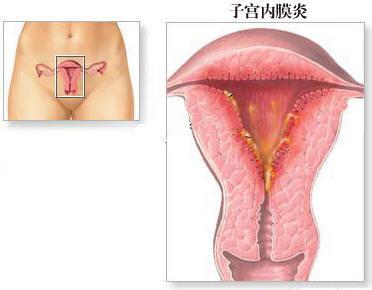 如何治疗子宫内膜炎 什么是子宫内膜炎 子宫内膜炎如何治疗