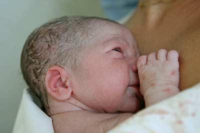 新生儿脓疱疮 什么是新生儿脓疱病 新生儿脓疱病治疗措施