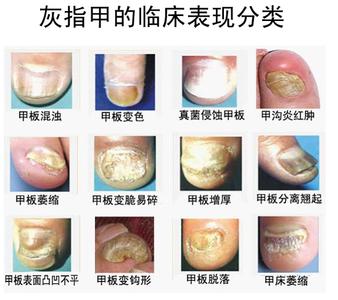 怎么治疗灰指甲最有效 最有效治疗灰指甲的方法