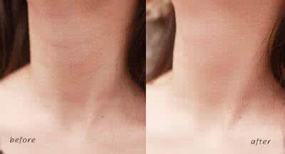 怎么预防颈纹 颈纹是怎么形成的 颈纹的预防和治疗