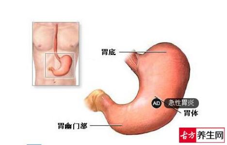 急性胃炎治疗方法 急性胃炎怎么办 急性胃炎治疗方法