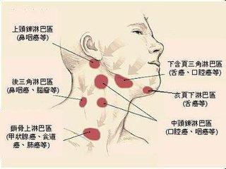 颈前淋巴结肿大原因 脖子淋巴肿大什么原因