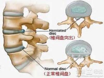 治腰椎盘突出的好方法 有关腰椎间盘突出的治疗方法