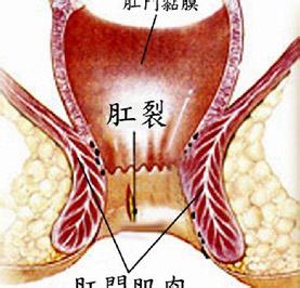 什么是肛裂的症状 什么是肛裂的症状 肛裂的主要症状有哪些