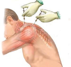 治疗肩周炎用什么方法 有什么好的方法治疗肩周炎