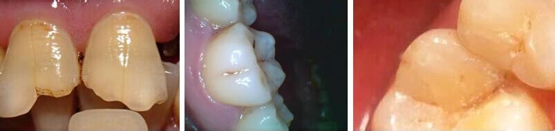 牙隐裂原因 导致牙隐裂的原因