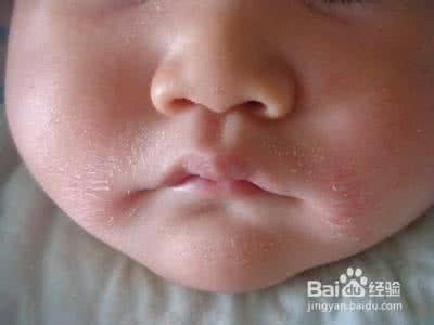 新生儿湿疹症状和护理 宝宝湿疹的护理常识 新生儿得了湿疹怎么办