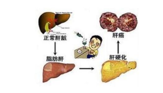 脂肪肝并发症 脂肪肝是如何形成的 脂肪肝并发症和治疗