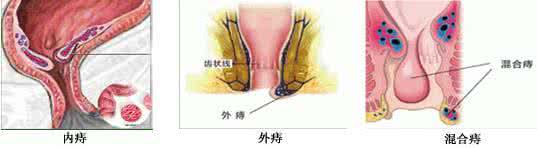 痔疮的形成与治疗 痔疮病是怎么形成的 如何治疗痔疮病