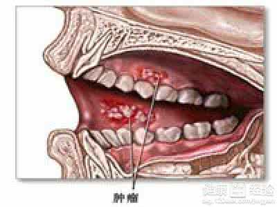 口腔癌是什么症状 口腔癌的是什么