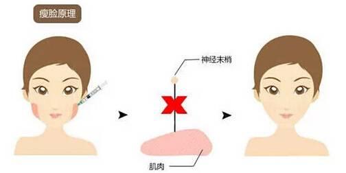 瘦脸针是什么原理 瘦脸针瘦脸的原理是什么