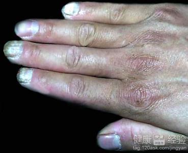 手癣脱皮怎么治疗方法 手癣是怎么形成的 手癣的治疗方法