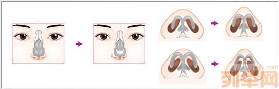 大鼻头整形方法 鼻头整形方法有哪些