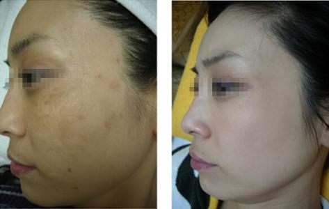 黄褐斑治疗最佳方法 黄褐斑治疗方法