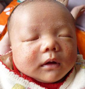婴儿湿疹最佳治疗方法 婴儿湿疹最佳的治疗方法