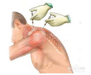 肩周炎最好治疗方法 肩周炎的最好的治疗方法