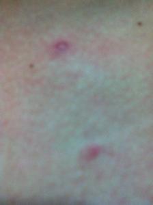 背上长痘痘的原因 背上和胸前长痘痘是什么原因