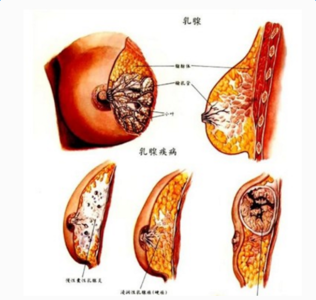 乳腺结节是怎么得的 乳腺结节形成的原因