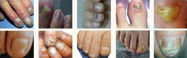 灰指甲对人体的伤害 灰指甲对人体有什么危害