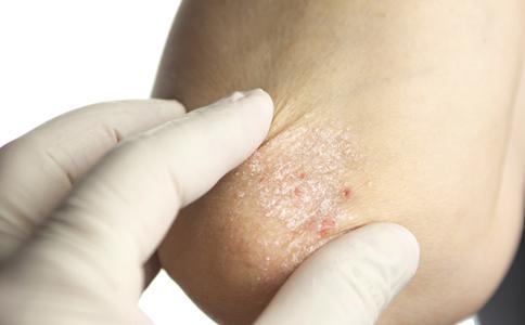 治疗湿疹最有效的方法 急性湿疹最有效的治疗方法