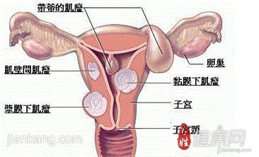 子宫肌瘤腹腔镜治疗 腹腔平滑肌瘤治疗方法