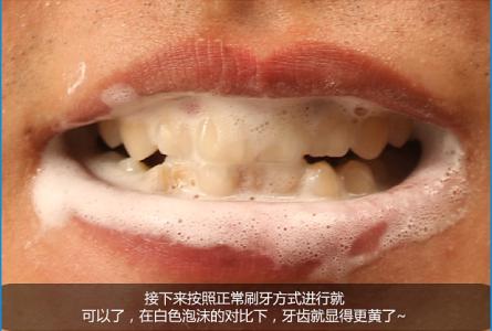 烟渍牙 烟渍牙的危害是什么