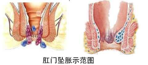 后肛门坠胀是什么原因 肛门坠胀的原因