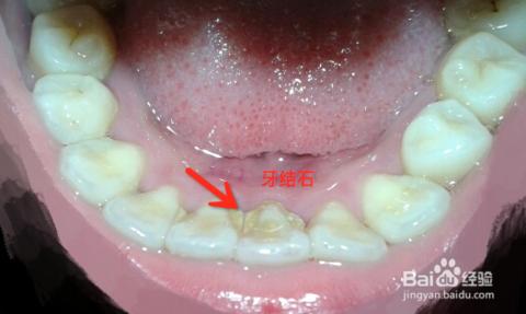 牙齿黄了怎么变白 洗牙能让牙齿变白吗