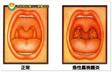 小儿扁桃体发炎症状 小儿扁桃体发炎的症状及治疗方法