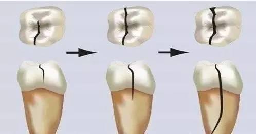 牙齿开裂怎么治疗 牙齿开裂的治疗方法