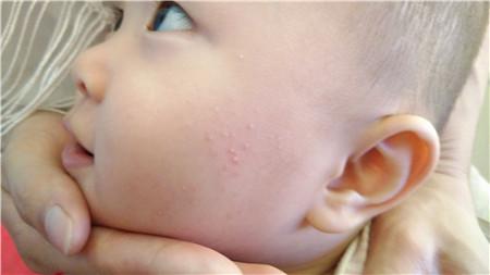 婴儿脸上湿疹怎么护理 宝宝脸上长湿疹怎么办 新生婴儿湿疹护理方法
