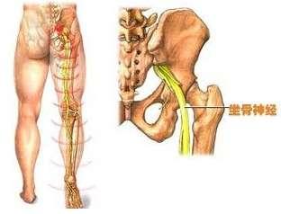 坐骨神经痛的锻炼方法 坐骨神经痛是什么原因引起的