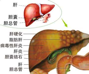 胆囊息肉怎么治最好 治疗胆囊息肉