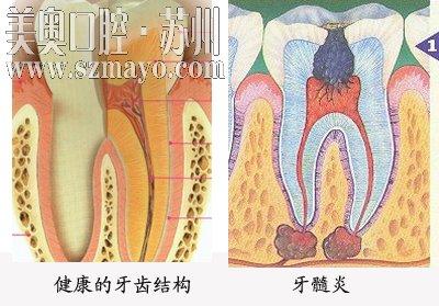 牙齿发炎拔了会怎么样 牙齿发炎能拔牙吗