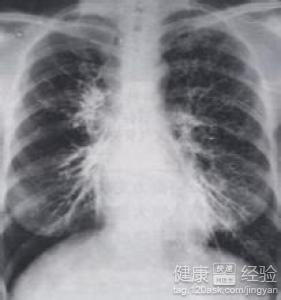 肺纤维化的症状 可怕的纤维化