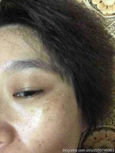 黑斑能去掉吗 怎么去黑斑