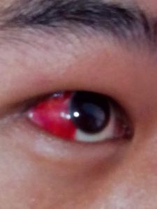 右眼出血怎么回事啊 眼睛出血是怎么回事