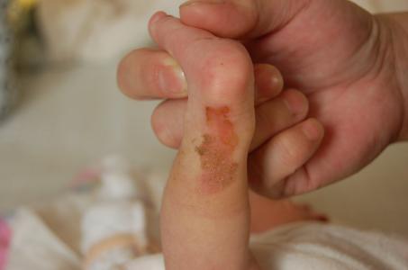 新生儿房间隔缺损症状 新生儿皮肤缺损症怎么办