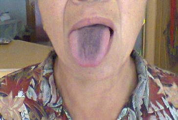 舌头中间黑是什么原因 舌苔发黑是什么原因？