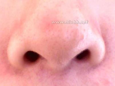 鼻咽癌的早期症状 鼻子有血丝是怎么回事