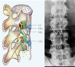 椎间盘突出症治疗方法 急性椎间盘突出症的治疗方法