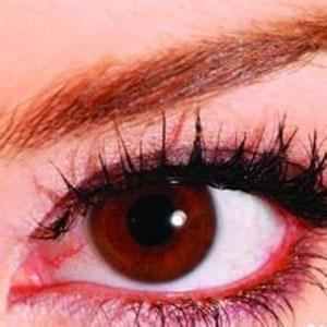 角膜炎是红眼病吗 角膜炎是什么