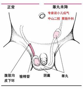 婴儿疝气是怎么引起的 小儿疝气形成的原因