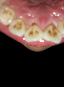 牙齿黑色污垢是蛀牙吗 牙齿黑色污垢怎么去除