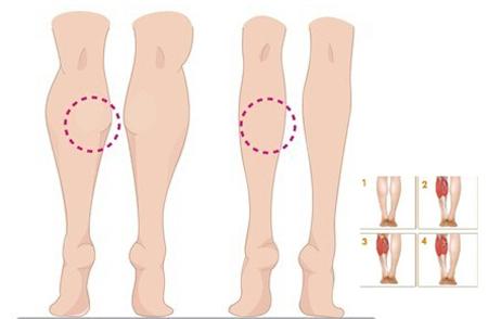 瘦腿针副作用 瘦腿针副作用_瘦腿针副作用是什么