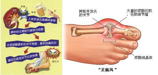 痛风吃什么食物最好 痛风是怎么形成的